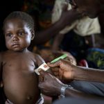 Un enfant malnutri en RDC CP:DR